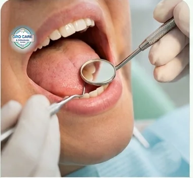 Dentist using a mouth mirror to visually examine a patient's mouth during oral cancer screening
